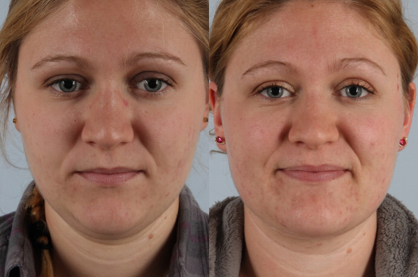 before and after liposuction female patient front view case 4776