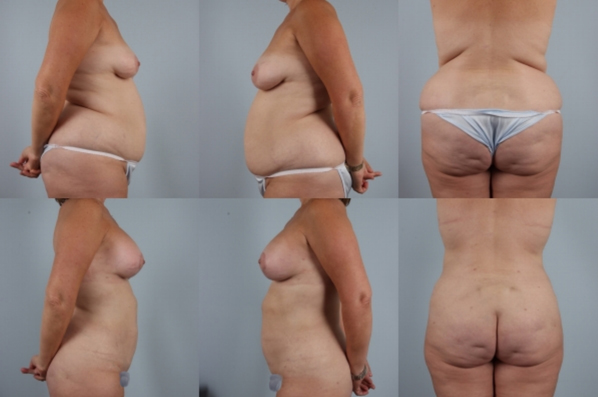 before and after liposuction female patient multiple angle view case 4781