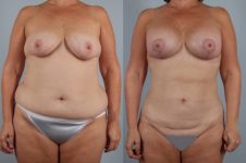 before and after liposuction female patient front view case 4781