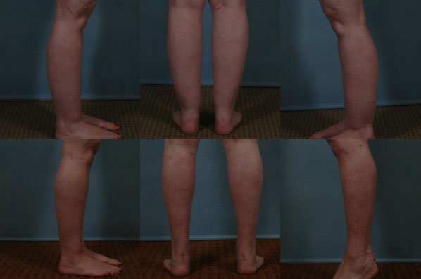 before and after liposuction female patient multiple angle view of legs case 4790