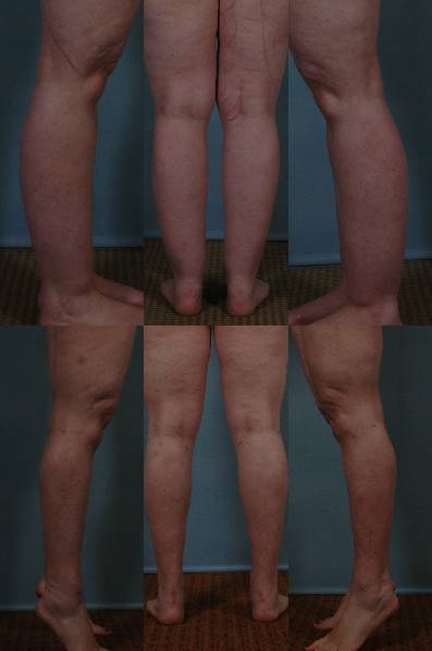 before and after liposuction female patient multiple angle view of legs case 4790