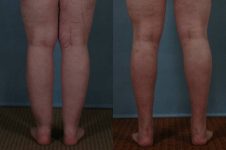 before and after liposuction female patient back view of legs case 4790