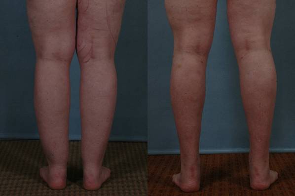 before and after liposuction female patient back view of legs case 4790
