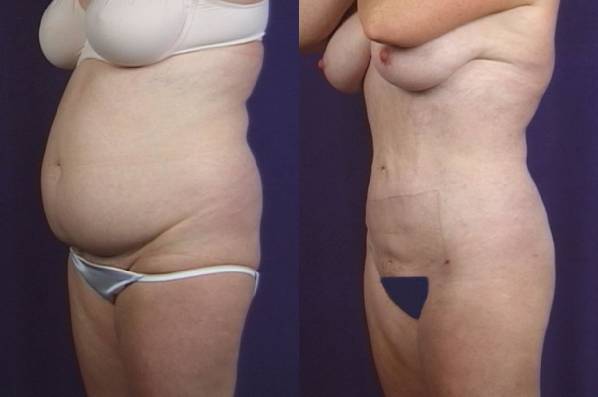 before and after liposuction female patient left diagonal view case 4795