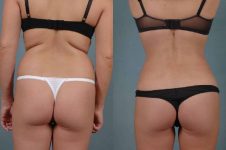 before and after liposuction female patient back view case 4798