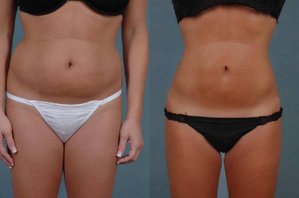 before and after liposuction female patient front view case 4798