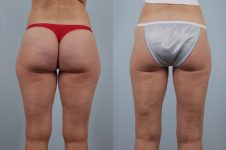 before and after liposuction female patient back view case 4809