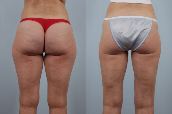 before and after liposuction female patient back view case 4809