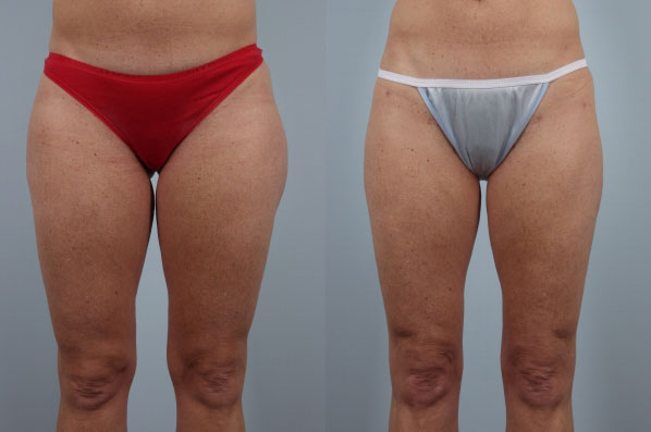 before and after liposuction female patient front view case 4809