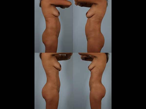 before and after liposuction female patient left and right side view case 4813