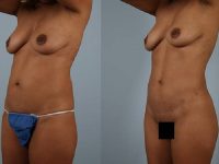 before and after liposuction female patient left diagonal view case 4813