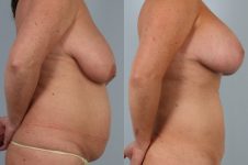 before and after liposuction female patient right side view case 4819