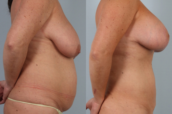 before and after liposuction female patient right side view case 4819