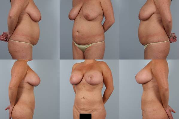 before and after liposuction female patient multiple angle view case 4819