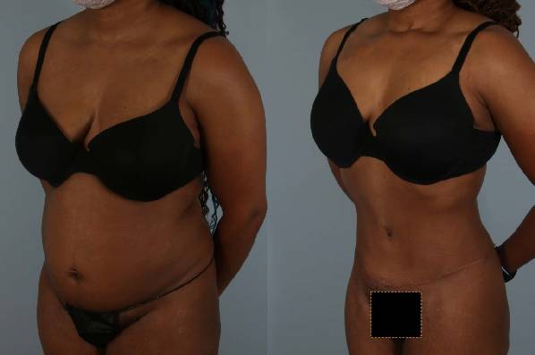 before and after liposuction female patient left diagonal view case 4843
