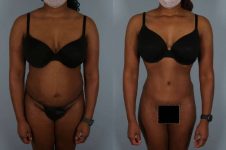 before and after liposuction female patient front view case 4843