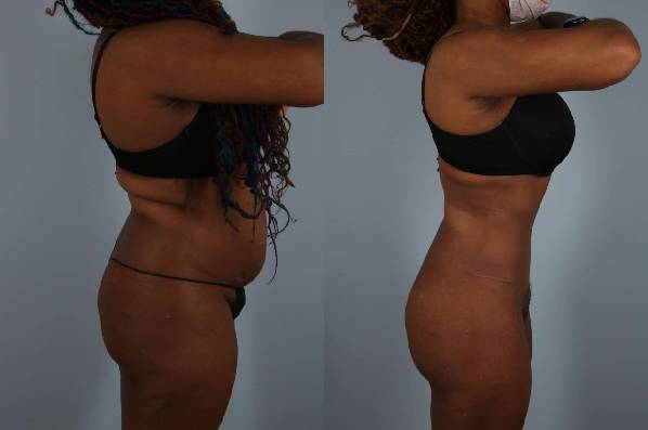 before and after liposuction female patient right side view case 4843