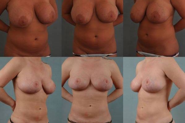 before and after liposuction female patient multiple angles view case 4806