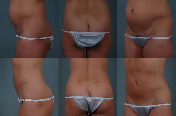before and after liposuction female patient multiple angles view case 4787