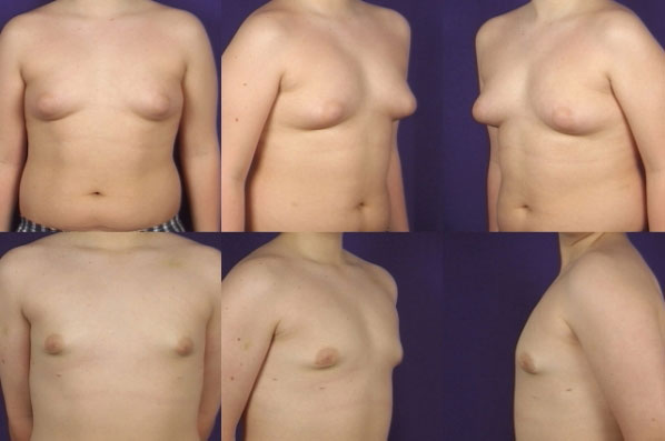 before and after male breast reduction multiple angle view