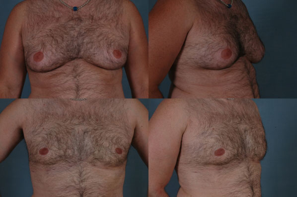before and after male breast reduction multiple views