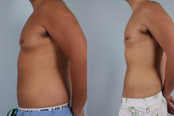 before and after male breast reduction left side view