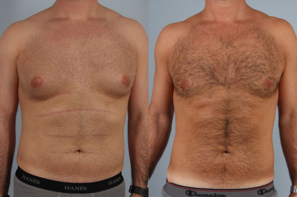 before and after male breast reduction front view