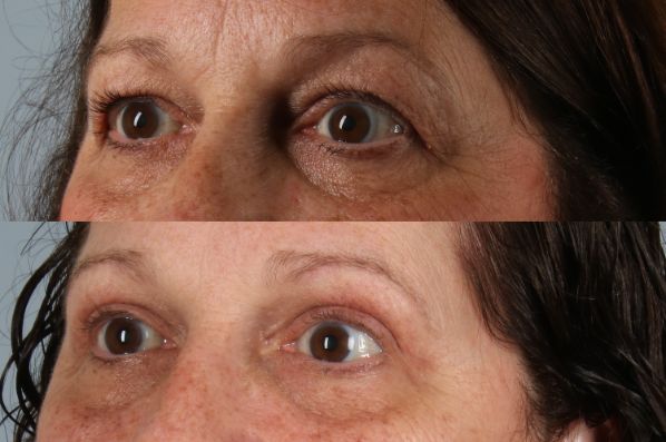 before and after eyelid surgery female patient left angled view case 8364