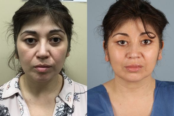 before and after facial fat grafting female patient front view case 8377