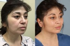 before and after facial fat grafting female patient right angled view case 8377