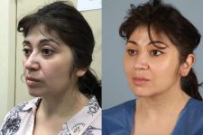 before and after facial fat grafting female patient left angled view case 8377