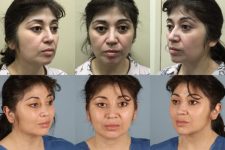 before and after facial fat grafting female patient multiple angles view case 8377