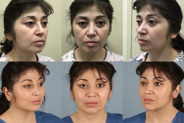 before and after facial fat grafting female patient multiple angles view case 8377