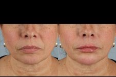 before and after facial rejuvenation female patient front view case 8775