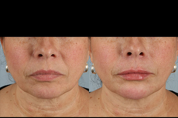 before and after facial rejuvenation female patient front view case 8775