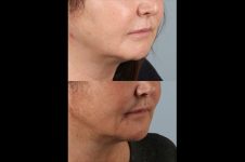 before and after facial rejuvenation female patient right angled view case 8771
