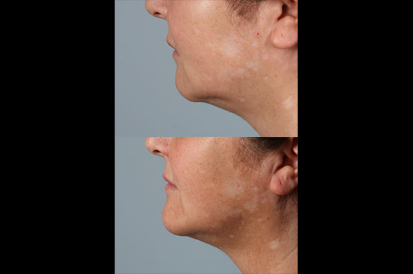 before and after facial rejuvenation female patient left side view case 8771