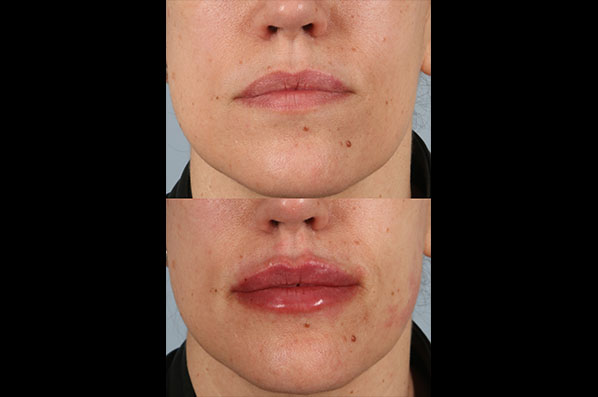 before and after facial rejuvenation female patient front view case 8788