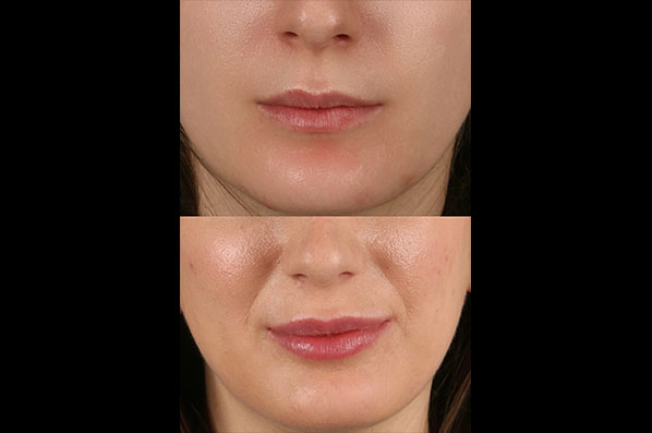 before and after facial rejuvenation female patient front view case 8792