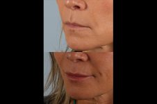 before and after facial rejuvenation female patient left angled view case 8794