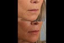 before and after female patient right angled view case 8794