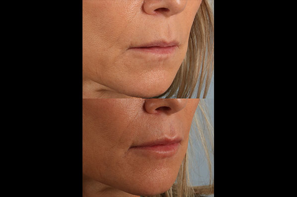 before and after female patient right angled view case 8794