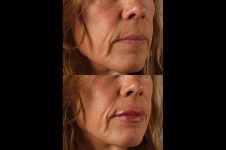 before and after facial rejuvenation right angled view case 8801